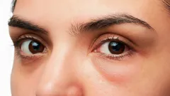 Come ridurre il gonfiore del viso al mattino e perché succede: lo spiega uno stilista